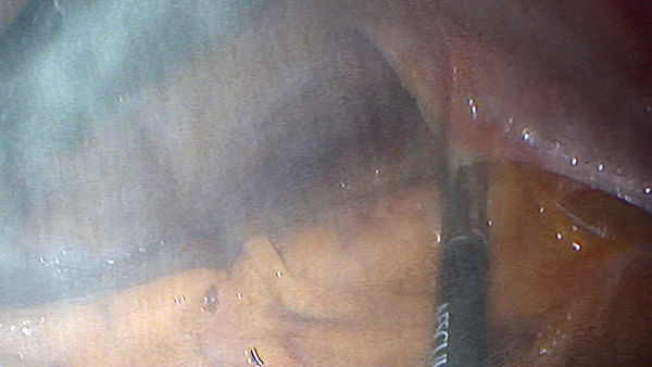 EinsteinVision® en chirurgie laparoscopique avec réduction de la fumée